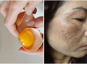 Bí kíp chữa nám da mặt bằng trứng gà dùng 1 lần da mặt đẹp cả đời